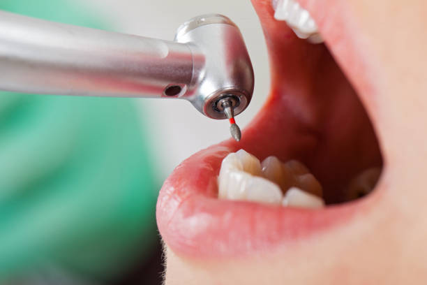 Emergency Dental Filling Replacement in AR